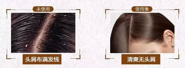 告別脫發、頭皮屑與頭發稀少的煩惱，重塑烏黑濃密的秀發